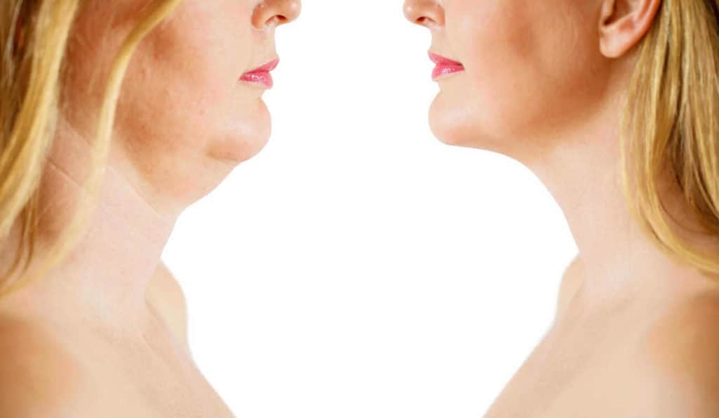 Double Chin treatment Acton before and after results