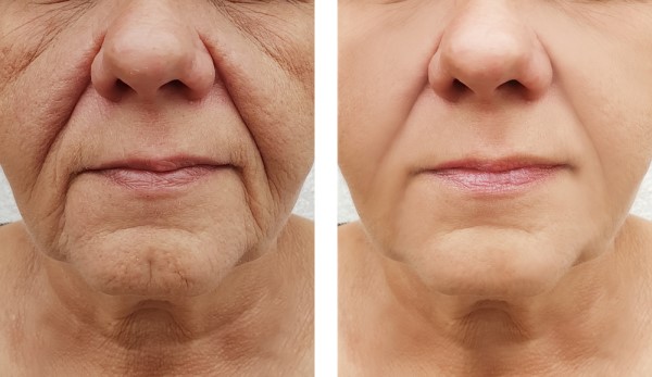 Learn more about Morpheus8 Treatment Acton today!