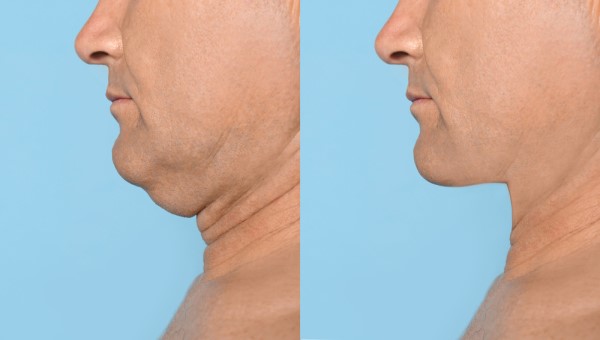 Which Non-Surgical Treatments Work Best for Jowls and Loose Skin Acton?