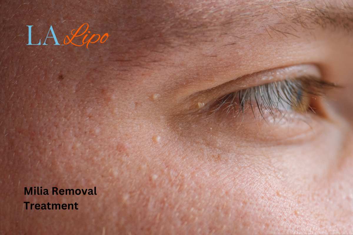 Cryopen Milia Removal: Is It the Easiest and Safest Option Acton?