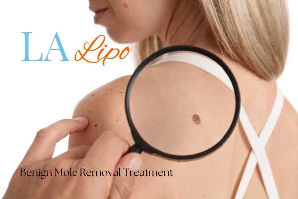 Woman having her inspection of blemish before mole removal Acton
