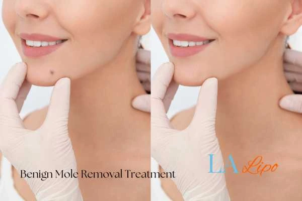 Before and after mole removal Acton treatment