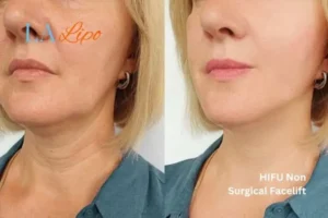 hi-fu for wrinkles Acton before and after results