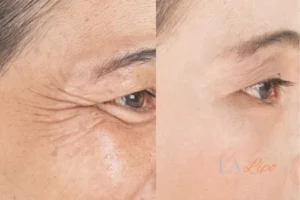 Before and after results of woman - HI-fu wrinkles reduction treatment Acton