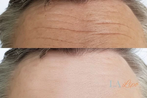 results of HIFU Acton on mans forehead to help reduce lines and wrinkles