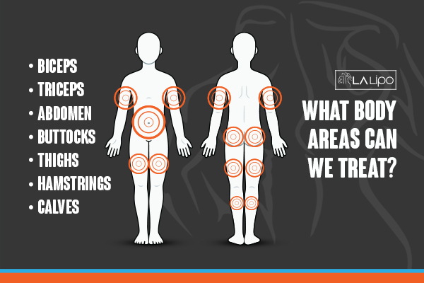Graphic to show areas you can have LA-EMS Body Sculpting Acton treatment.