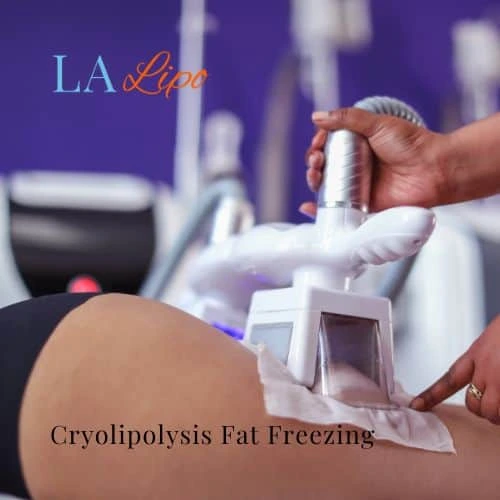 fat freezing - Cryolipolysis Acton