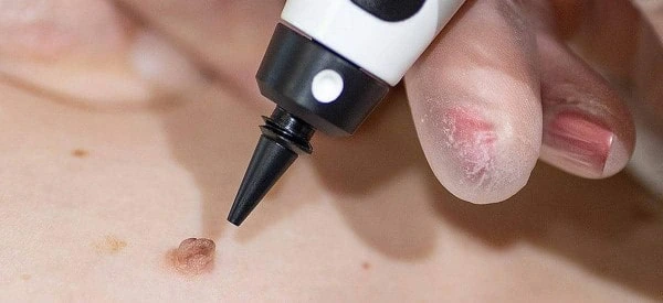 skin tag removal using cryopen Acton