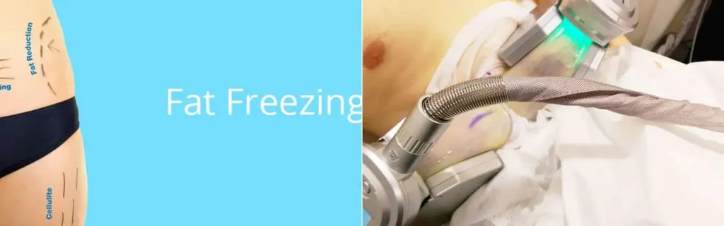 Fat freezing Acton on multiple areas of the body