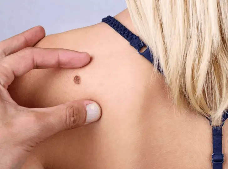 woman having mole removal Acton consultation before treatment.