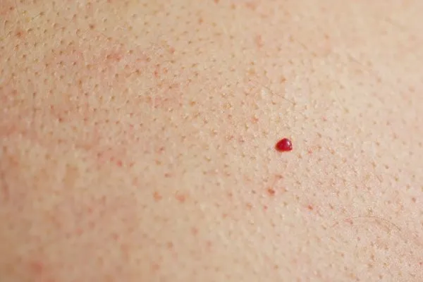 close up of a cherry angioma Acton