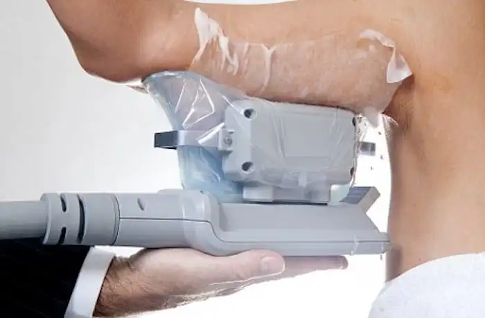 Picture of fat freezing Acton on the upper arms.
