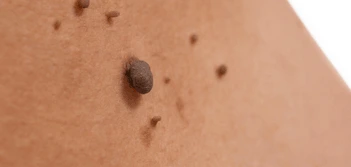 image of a skin tag Acton