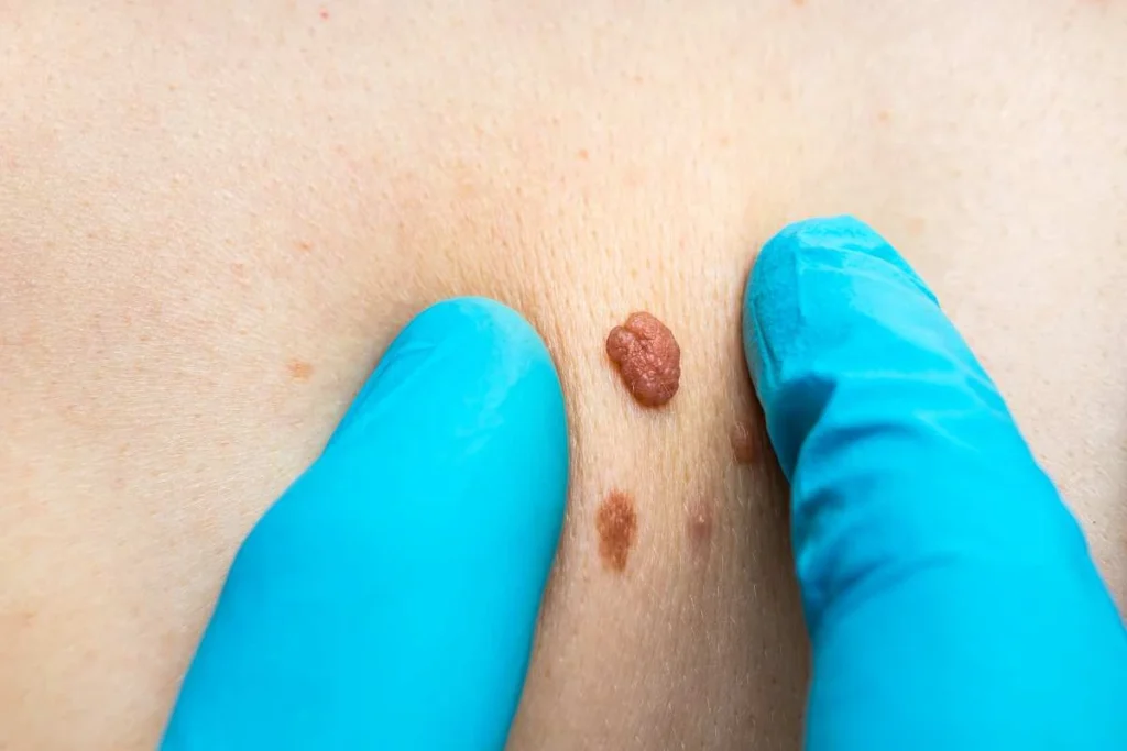 Consultant examining a skin tag Acton