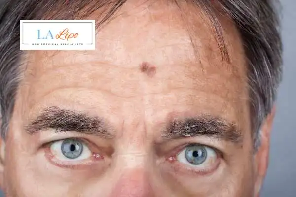 Solar Lentigo Removal Acton image of man with mark on his forehead