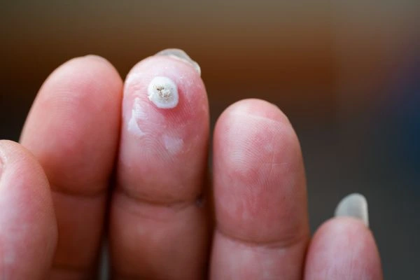 wart on person finger - cryotherapy to treat from LA LIPO Acton
