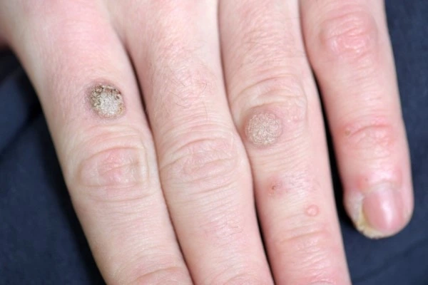 photo of warts on person hand - see wart removal Acton from LA LIPO