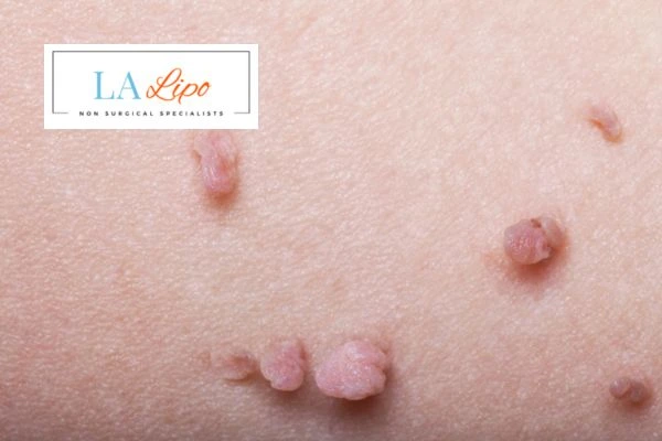 Does cryopen skin tag removal Acton hurt? Find out now call our team today!