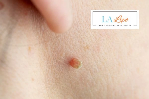 Book skin tag removal Acton today speak to our team now!