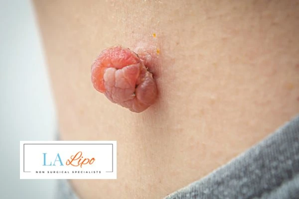 Interested in skin tag removal Acton? Concerned about the pain? Find out more today!