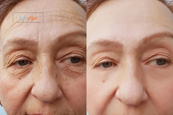 The powerful benefits of Morpheus8 Treatment Acton - Call Our team today!