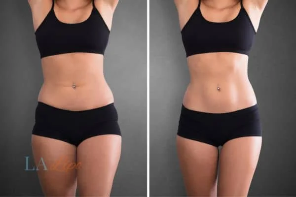 before and after results of non-surgical treatment to help a woman's body image and mental health Acton