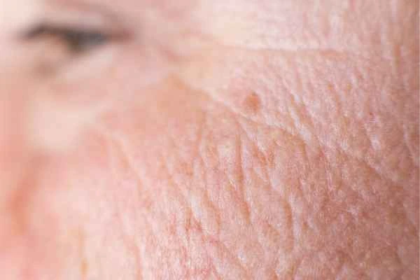 close up picture of a woman's face showing an age spot Acton