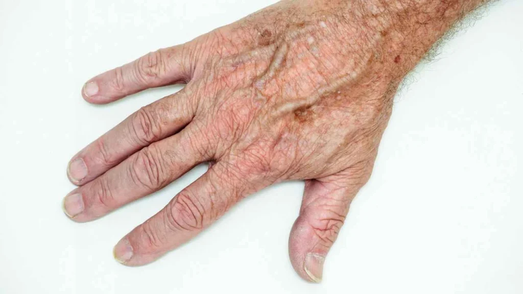 Male hand showing age spot Acton