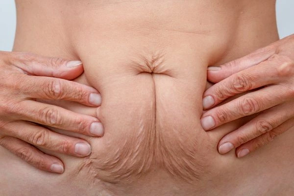 Image of a woman's stomach with loose skin - example of skin tightening Acton options