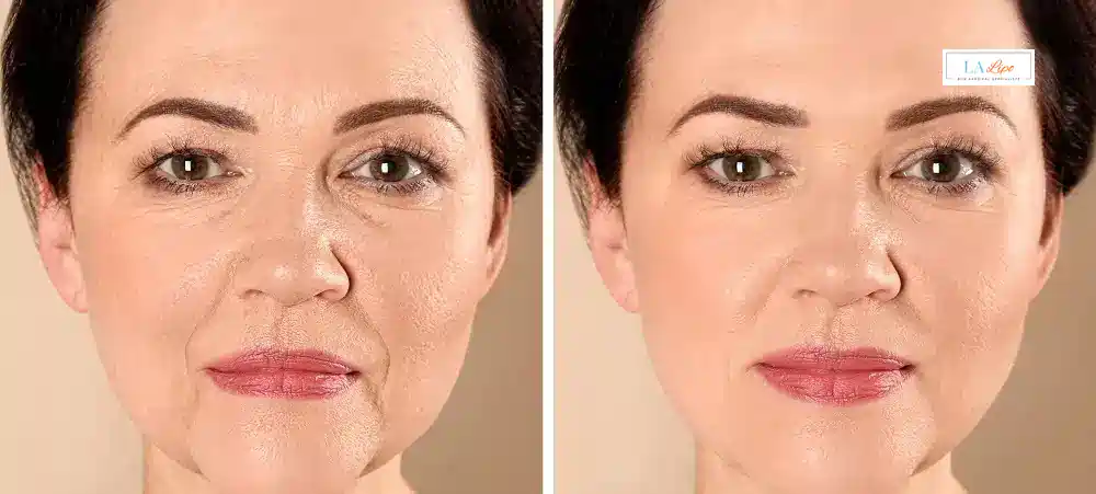 How Long Does It Take to See Results and How Long Do They Last Acton?