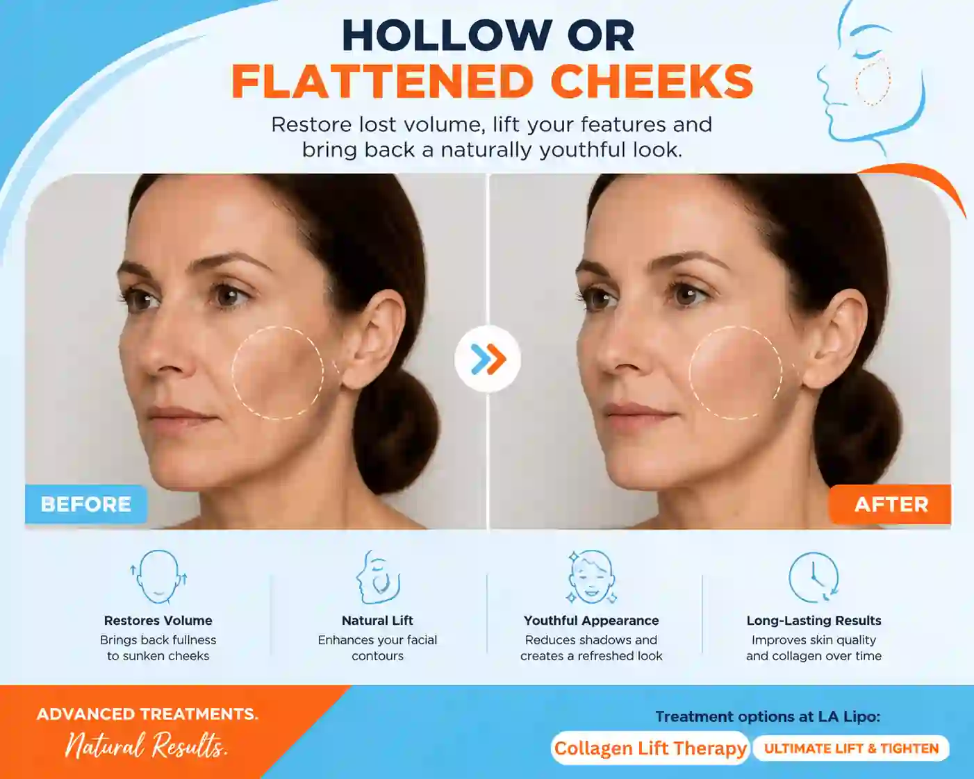 Sign #4: Hollow or Flattened Cheeks Acton