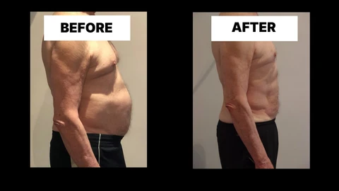 What Symptoms Can Diastasis Recti Cause in Men? Weak Core, Back Pain and Poor Posture Acton